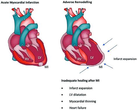 left ventricular dilatation after infarction